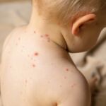 Meningitis infantil: síntomas de alerta, prevención y por qué cada hora cuenta