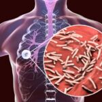 Tuberculosis: síntomas, cómo se transmite y por qué sigue siendo un problema de salud pública